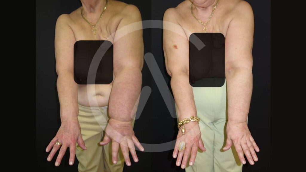 Λεμφοίδημα στο χέρι (Άνω Άκρου) πριν-μετά | Φωτογραφία Ασθενή #3
